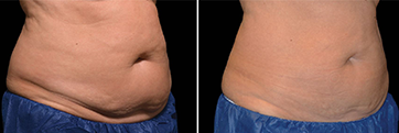 woman using coolsculpting elite on another womans stomach
